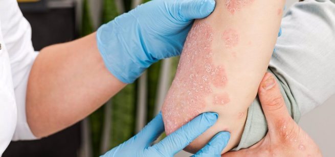 10 mitos y dudas frecuentes sobre la psoriasis